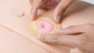 2mm/4mm Ostomy Moldable Barrier Rings Seal Gap Prevent Leaks