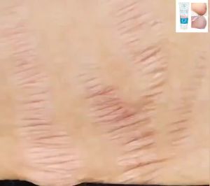 Anti Stretch Mark Cream scar cream Pregnancy Scar Removal Repair Cream Stretch Marks Whitening Fades Stretch Marks Repair Scar Slack Line Skin Care