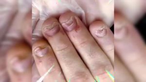 Nail Fungus Ointment Paronychia Removal Anti Gray Nail Repairing Brighten Infection Fingernail Toenail Onychomycosis Care Cream