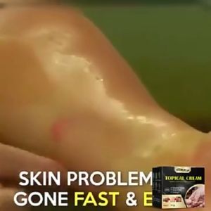 Kem Bôi Ngoài Da Thảo Mộc Nấm ngứa Chàm Tổ Đỉa Ghẻ Nước