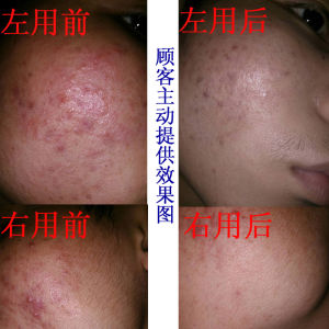 Acne Removal Water Large Bottle 500ml for Old Customers Pimple Removal Blackhead Removal Anti-acne Chinese Beauty Skincare