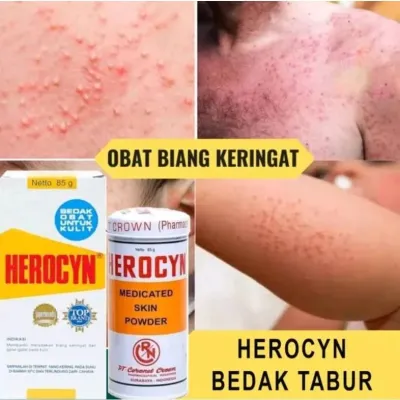 BEDAK HEROCYN 85g UNTUK GATAL- GATAL KULIT