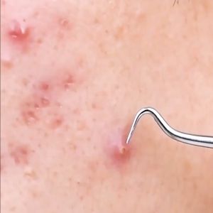 4pcs/set Dual Heads Acne Needle Blackhead Blemish Squeeze Pimple Extractor Remover