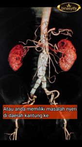 PECAH BATU Obat Batu Ginjal Sakit Pinggang Penghacur Batu Ginjal Infeksi Saluran Kemih Kencing BPOM Binasyifa 60 Kapsul Herbal