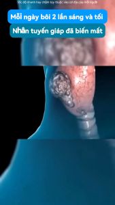 Kem tan u Tuyến Giáp Senjoko Nhật Bản 50GR -Tan U Tuyến Giáp Cường Giáp Hiệu Quả