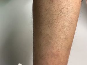 Painless Hair Eraser for Arms Legs Hands Bikini Area with Exfoliating Surface