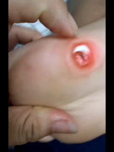 Plester Mata Ikan Plester Obat Kutil Foot Corn Removal Penutup Kutil Obat Mata Ikan Kapalan Caplak plaster Mata ikan Obat Kutil Plester Kutil Ampuh Jiyantie Plester mata ikan