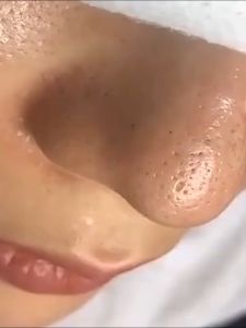 2023 ไม้กดสิว เครื่องกำจัดสิวเสี่ยน ไม้สิวเสี้ยน อุปกรณ์สำหรับกามณ์กิจกรรม เช่น สิวแดง สิวแดงที่รู้ สิวเสี้ยน สิวหัวขาว สิวหัวดำ สิวอักเสบ เป็นต้น