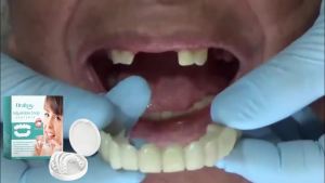 oralhoe | Adjustable Snap Dentures for Missing Teeth Filling Repair Broken Secure Grip Natural Chewing Upper or Lower Jaw with Storage Box