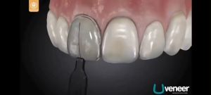 32/30PcsDental Instruments Veneers Mould Composite Resin Light Cure Anterior Front Teeth WhiteningFront Teeth