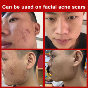 Scar removal cream Scar Care for Scars and Keloids cream skin care cream Acne Care | Effective On Scar Falls Surgery Burn Cuts Scratches and Insect Bites | Improve Appearance Of Burn Scar Acne Stretch Marks - 50g
