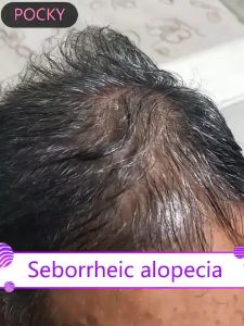 Anti Hair Loss Shampoo Gentle Ginger Shampoo  Scalp Purify Shampoo 500ml Refreshing Oil-Removing Anti-Break Shampoo Hair Care Repair Scalp for Regrowth Hair Loss Itching Dandruff