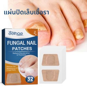 32 ชิ้น/กล่อง Universal Nail Ditch Repair Patch ขนาดกะทัดรัดเล็บสติกเกอร์คุด Toenail Correction สติกเกอร์ Foot Care