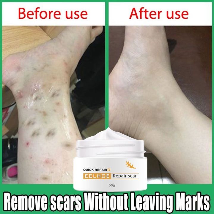 Scar Remover for Old Scar on Leg Scar Gel Original Stretch Mark Remover