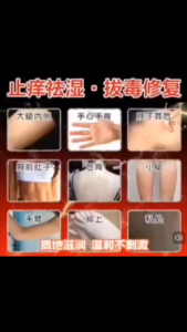 Natural Herbal Psoriasis eczema urticaria sweat herpes dermatitis itchy skin antibacterial cream