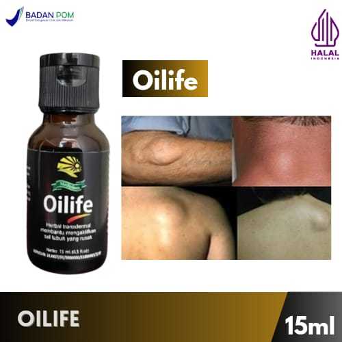 Oilife Obat Benjolan Original Asli Bpom Obat Minyak Oles Mengatasi