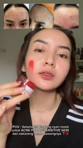 Adleeva Skincare Acne Revive Calming Moisturizer Gel 30gr Meredakan Iritasi Kulit Berjerawat