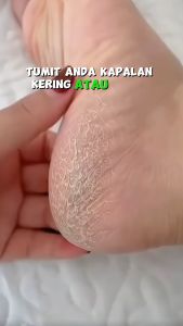 TUMITKU 30ML BPOM MERAWAT KULIT KAKI HILANGKAN KAPALAN TUMIT