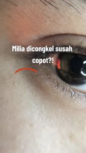 PAKET KHUSUS MILIA SYRINGOMA !! Paket 2in1 milia syringoma Cream & serum yang di formulasikan khusus untuk mengatasi milia serum cream Leika Skincare