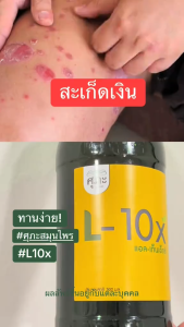 (ศุภะ) L-10X แก้สะเก็ดเงิน น้ำเหลืองเสีย สูตรใหม่ชนิดน้ำ - 300 มล.