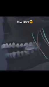 Dụng Cụ Tập Cơ Hàm Định Hình Gương Mặt - Jawline Exerciser 3 Cấp Độ Tăng Cường Độ Săn Chắc Và Nét Mặt Tự Nhiên