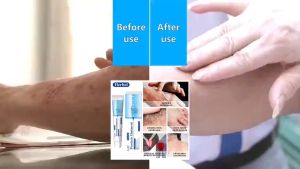 100% Valid Psoriasis Cream Psoriasis Ointment Antibacterial Cream Eczema Treatment Anti Fungal Cream