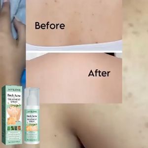 SG Seller Back Body Acne Treatment Spray Refining Control Prevent Pimple Moisturizing Redness Calm Soothe Pores 120ML