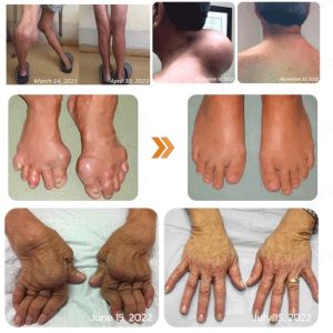 Hot sale Jointment Cream Bee Venom Treatment Gel Ubat Sakit Lutut Dan Sendi Auto Relief Knee Pain Original Joint Pain Relief Gel20g痛风膏