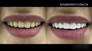 Snap on Smile Veneer Gigi Palsu Original Asli Lepas Pasang Atas Bawah Permanen Kuat Bisa Buat Makan Siap Pakai Pria Wanita Dewasa