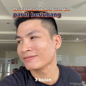 RAU Acne Fading Serum Original For Men Dark Spots And Restores Skin Supports Reduction Pitted Scars Nourish skin - RAUMEN Serum untuk parutjerawat Melembutkan kulit Memudarkan Mencerahkan Kulit umtuk lelaki