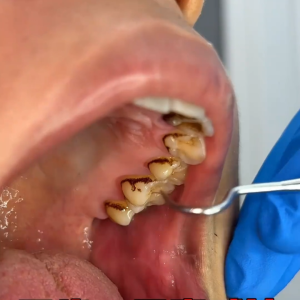 LYDIMOOON Probiotic Whitening Toothpaste packed with probiotics and natural herbal formulas effectively removes tobacco stains and tooth stains freshens breath and leaves your teeth bright and white.