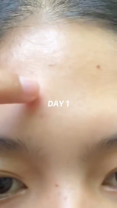 20% Azelaic Acid Acne Cream 30g: Effectively treats acne removes blackheads fades acne scars and pigmentation and repairs skin.