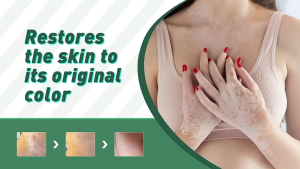 UTOUR Vitiligo Cream Japan Herbal formula Vitiligo Treatment Cream White Spots repair white spot 20g (SWEAT SPOT WHITE SPOT PIEBALD)...