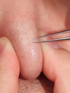 7 Acne Needle Kit Blackhead Removal Needle Tool Stainless Steel Tweezers Acne Extractor Stainless Steel Acne Needle Blackhead Removal Pore Removal Kit Facial Skin Care Tool Facial Pore Cleaner Facial Skin Treatment Beauty Tool