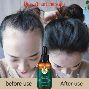 Hair Loss Treatment Ginger Essential Hair care herbal essence Fast Hair Growth Essential Oils Essence Ginger Hair Nutrition Liquid 30ml Repair Hair Follicles Preventing Baldness Regrowth Hair Nourishing Hair root Thinning Hair Treatment 生薑生髮護髮液 防脫髮液