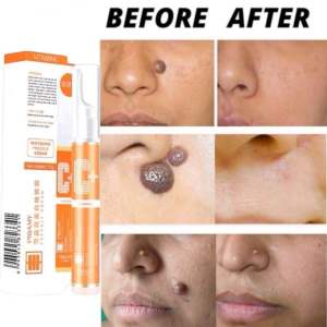Mediacted cream penanggal ketuat kutil jeragat tahi lalat bintik hitam skin tag removal mole