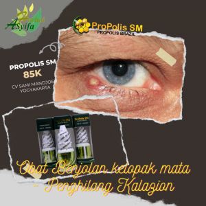 Obat Benjolan kelopak mata - Penghilang Kalazion - mata bintitan - mata bengkak sebelah Kanan / Kiri - Hordeolum - Propolis SM