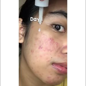 GLOW FX Acne Pure Serum - Serum Untuk Jerawat Meradang 4% Niacinamide Untuk Kulit Kompleks 7 Tanaman Menenangkan - Lazada