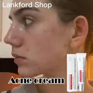Azelaic Acid Acne Gel Blackhead Removal Pore Shrinking Cream Oil Control Acne Jerawat Bintik Jeragat