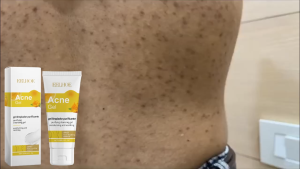 EELHOE Acne Gel 60ml - Gel chấm mụn làm sạch sâu lỗ chân lông hỗ trợ giảm mụn và kiềm dầu làm dịu da và giảm kích ứng kết cấu gel mát lạnh thẩm thấu nhanh phù hợp cho da dầu mụn dùng cho mặt và lưng