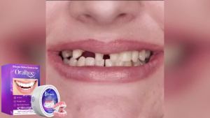 oralhoe | Temporary Dentures Set Cosmetic Teeth Veneers Natural Smile Snap On DIY Tooth Repair Kit False Teeth Cover Upper Lower 1 Set