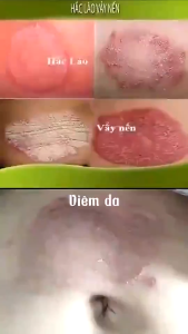 Kem Bôi Dứt Điểm Hắc Lào Nấm Da Đầu Ghẻ Nước Á Sừng NHẬT BẢN