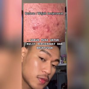MENS REACTION Cleanser for Acne Skin - 4Pcs Mens Reaction Facial Wash