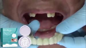 oralhoe | Snap on Denture Upper & Lower Temporary Teeth Dentures False Teeth Set Perfect Smile Adjustable Silicone Denture for Women & Men