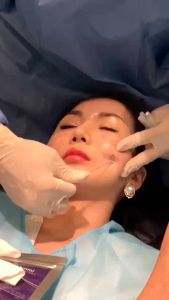 [ HCM ] Chỉ nâng cơ mặt dùng để căng thon gọn mặt giảm nếp nhăn chỉ collagen Ammi HOOK 1 bịch 20 sợi