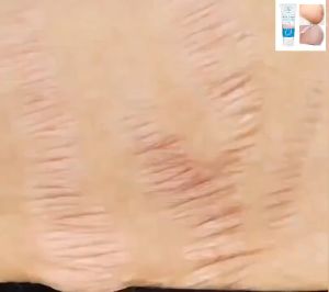 PrettyFloral~Anti Stretch Mark Cream scar cream Pregnancy Scar Removal Repair Cream Stretch Marks