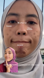 Hanasui Advance Exfoliating Serum - Kurangi Beruntusan Jerawat Komedo Cerah & Halus Lactid Acid Gylocic Acid Tranexamic Acid