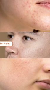 Serum Acne Sr12 Serum Kulit Wajah Berminyak Berjerawat Komedo Bruntusan Bpom Aman Bumil Busui