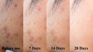 Completely cure acne acne gel acne cream Fast removal All types of acne hide acne adolescent acne Blackhead 20g