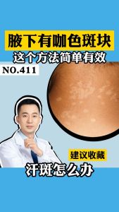 [New] Vitiligo Soft Spray Vitiligo Remover Tinea Versicolor Body Lotion Helps Get Rid of Sweat Spot Vitiligo Skin Vitiligo Clear Spray